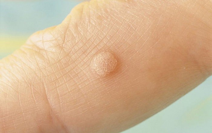 Vi nấm tạo các tổn thương da mạn tính với tính chất sùi như hạt cơm
